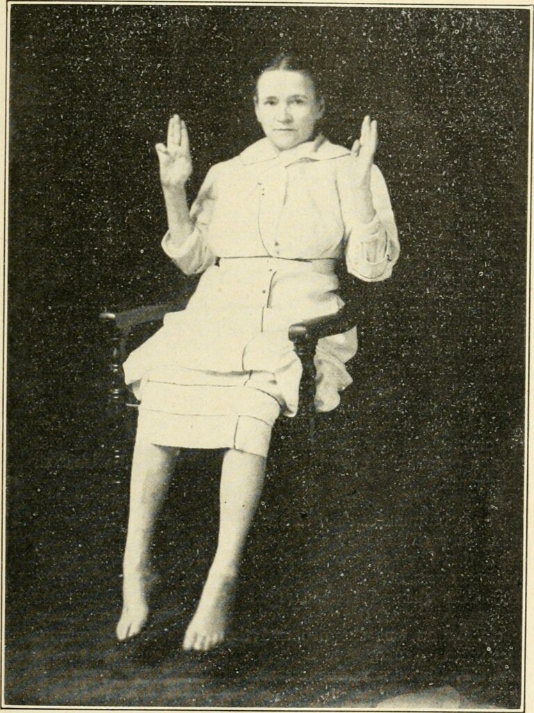 Girl with paralyzed hands. 